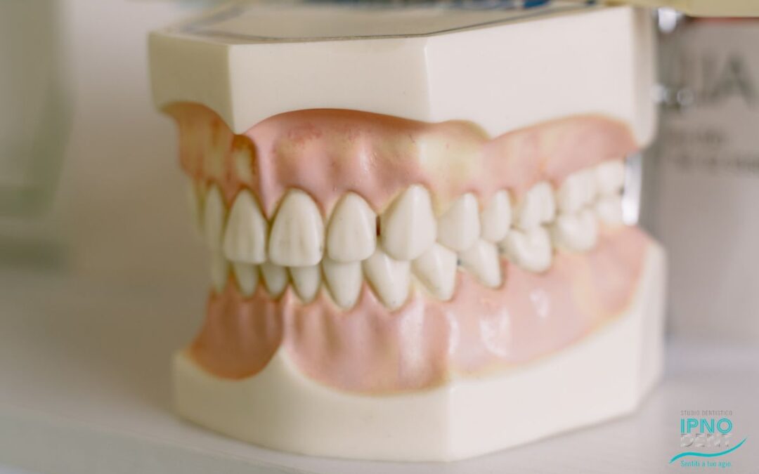 Bite Dentale, quando è necessario
