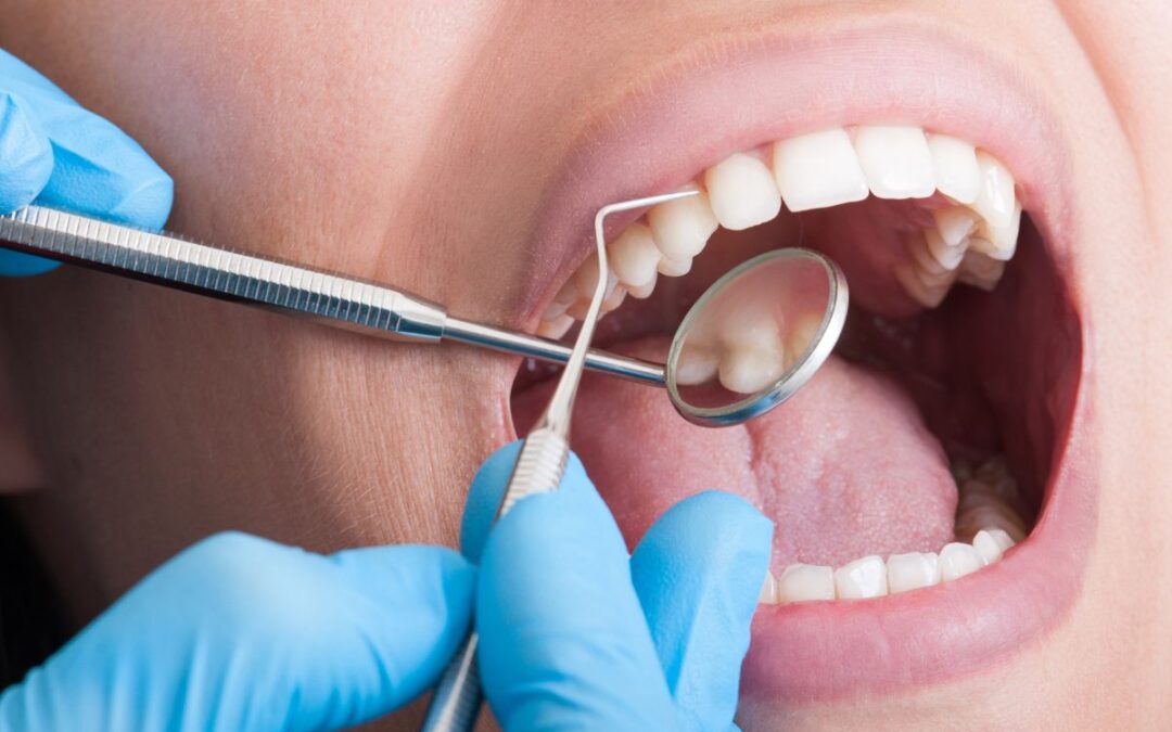 Dente rotto: cosa fare